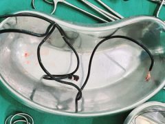 Хирург удивился, обнаружив в теле пациента неожиданный инородный предмет
