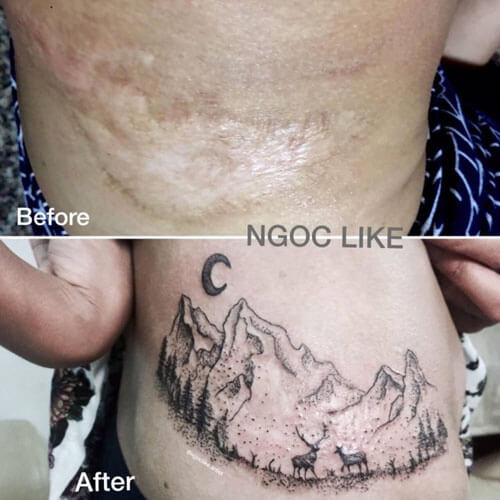 Молодая талантливая татуировщица помогает женщинам бороться со шрамами