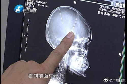 После компьютерной томографии пациентка узнала, что живёт с двумя иглами в мозге