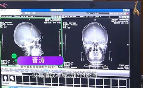 После компьютерной томографии пациентка узнала, что живёт с двумя иглами в мозге