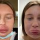 Удалив филлер из губ, женщина стала жертвой сильной аллергии