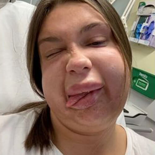 Удалив филлер из губ, женщина стала жертвой сильной аллергии