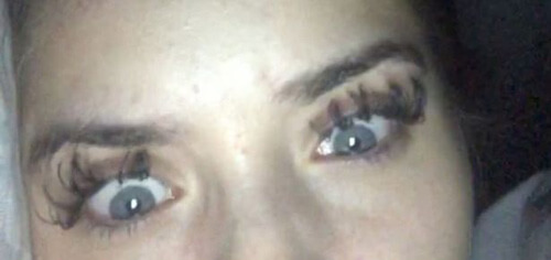 Из-за аллергической реакции на наращивание ресниц девушка не смогла открыть глаза