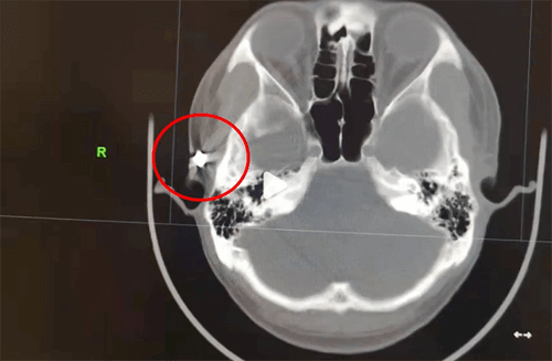 Хронические головные боли мужчины были вызваны пулей, застрявшей в черепе