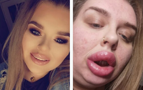 Из-за аллергии на губные филлеры женщина попала в больницу