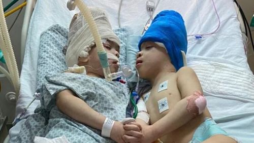 Хирурги разделили сиамских близнецов, сросшихся головами и мозгом