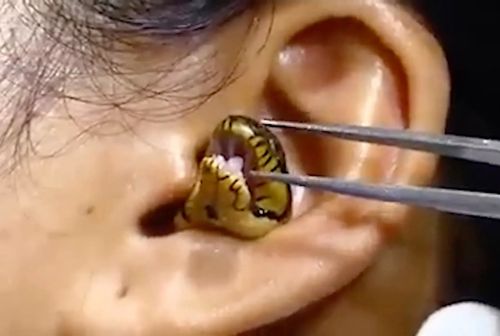 Видеоролик с извлечением змеи из уха женщины напугал многих людей