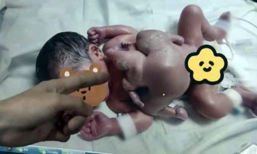 Младенец появился на свет с близнецом-паразитом, у которого были только руки и ноги