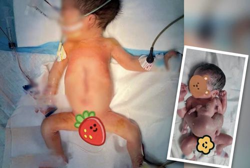 Младенец появился на свет с близнецом-паразитом, у которого были только руки и ноги