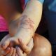 Маленький турист пострадал от аллергии на татуировку хной