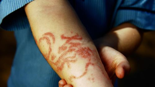 Маленький турист пострадал от аллергии на татуировку хной