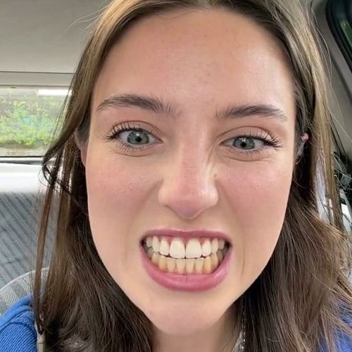Женщина отбелила верхние зубы, но не стала отбеливать нижние
