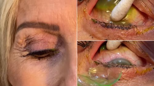 Пациентка с раздражением глаз почти месяц не снимала контактные линзы и копила их под веками