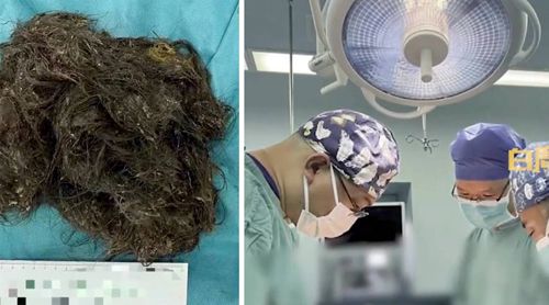 Хирурги удалили из желудка девочки комок волос, весивший 3 килограмма