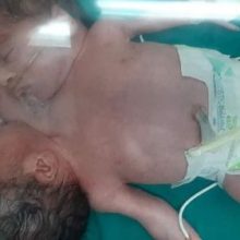 Женщина родила сиамских близнецов с двумя головами и четырьмя руками