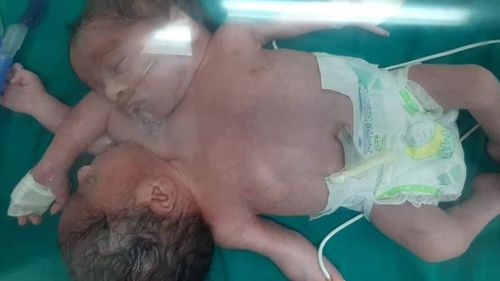 Женщина родила сиамских близнецов с двумя головами и четырьмя руками