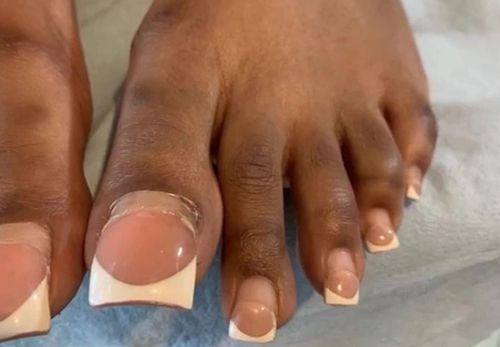 Дама умудрилась целых 13 недель ходить с акриловыми ногтями на ногах