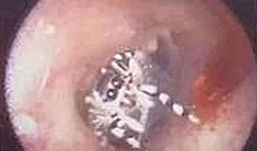 Пациентка, страдавшая от шума в ухе, выяснила, что там поселился и сплёл паутину паук
