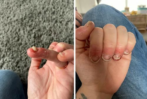 В результате аллергической реакции на маникюр у женщины начали отваливаться ногти