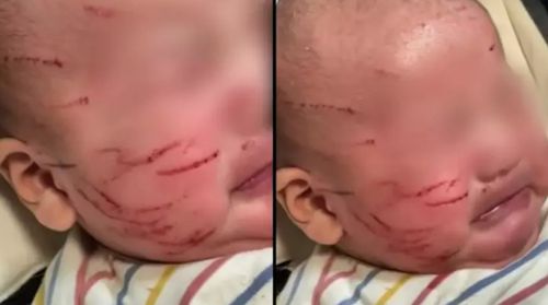 Малыша забрали из детского сада с многочисленными кровоточившими царапинами на лице