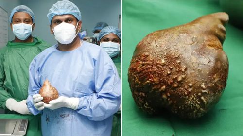 Пациент страдал от самого большого и тяжёлого почечного камня в мире
