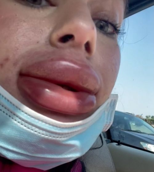 Польстившись на бесплатную инъекцию филлеров, женщина получила распухшее лицо и губы