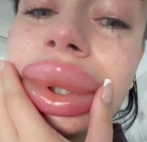 Польстившись на бесплатную инъекцию филлеров, женщина получила распухшее лицо и губы