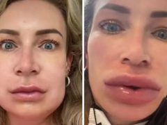 Из-за аллергии на филлеры у женщины увеличились не только губы, но и щёки