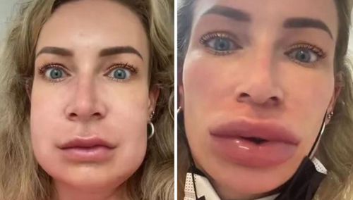 Из-за аллергии на филлеры у женщины увеличились не только губы, но и щёки