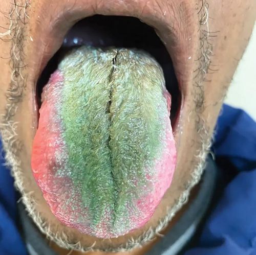 Из-за курения и приёма антибиотиков язык пациента зарос зелёными «волосами»
