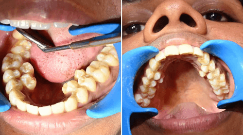 Женщина, у которой 38 зубов, попала в Книгу рекордов Гиннесса