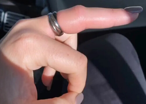 Женщина, заснувшая с кольцом на пальце, после не смогла его снять
