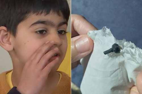 Мальчик два года прожил с деталью конструктора в носу