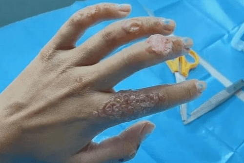 После татуировки хной у женщины остались шрамы на руке