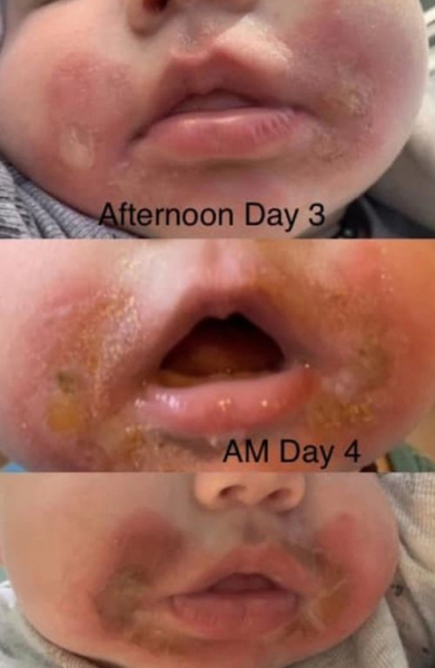 Маленькая девочка, пожевавшая сельдерей, получила повреждения кожи вокруг рта